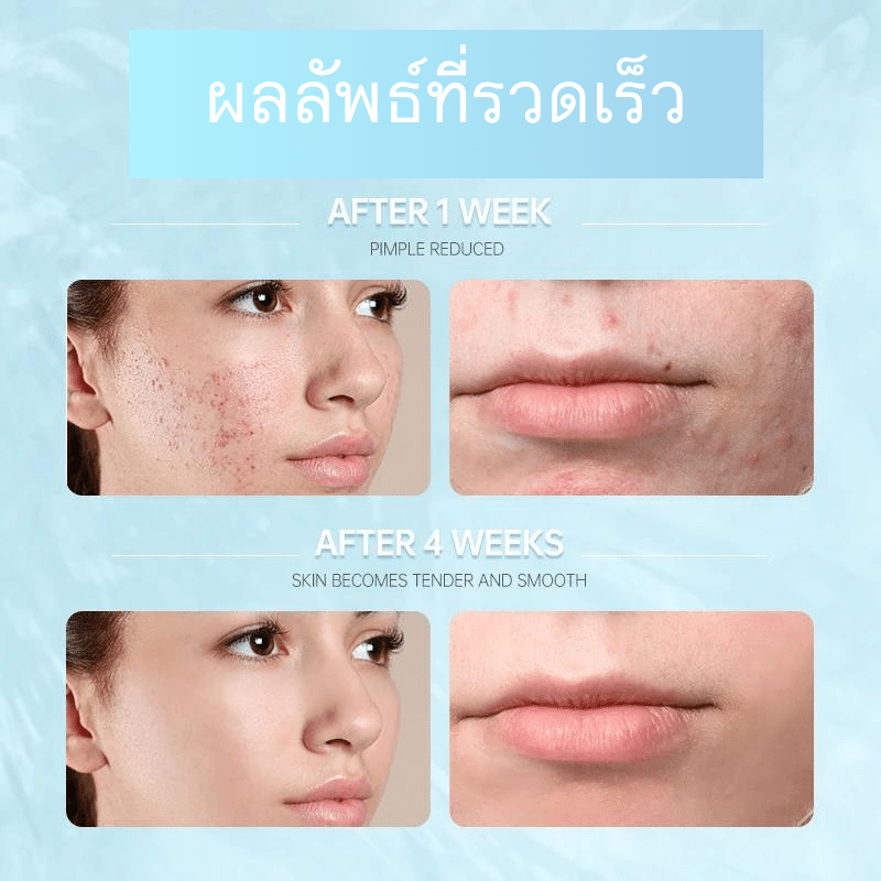 Acne treatment result